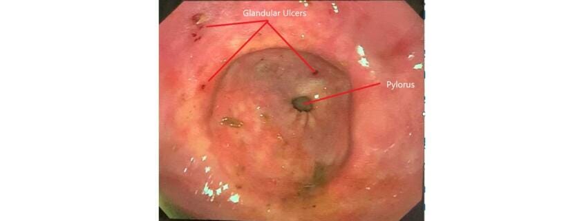 An equine glandular ulcer